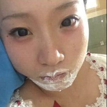 北京麗詩(shī)麗格楊明強(qiáng)玻尿酸豐唇半個(gè)月了，看看果~